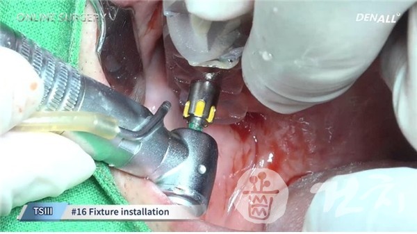 정현준 원장의 'Bilateral sinus graft and implantation with OneGuide System편 수술장면