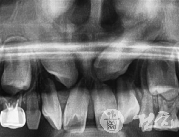 맹출 방향이 잘못된 송곳니가 앞니뿌리를 흡수시키고 있다. 이러한 문제를 모르고 방치시 심각한 문제가 발생할 수 있으며, 7세에 치아교정검진을 통해서 이러한 문제뿐아니라 골격성장의 문제여부도 확인할 수 있다.