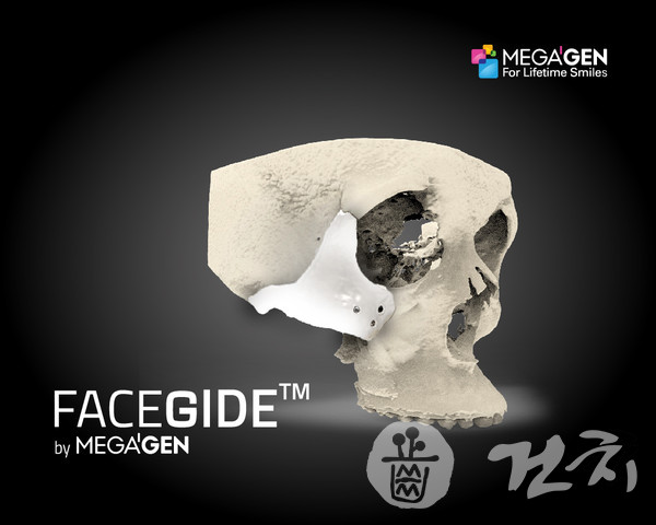 메가젠이 3D 디지털 시뮬레이션을 이용한 환자맞춤형 인공광대뼈를 개발했다.