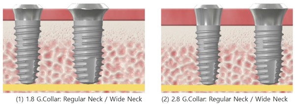 Gingiva Collar의 이원화